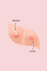 NudaSkin - Clear Patch™ Overnight Acne Relief